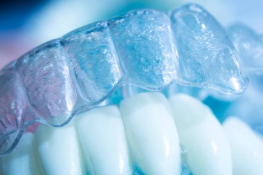 Modern görünmez parantez hizalayıcıları dişçiler tarafından dişlerin hizalanmasını düzeltmek için kullanılır.