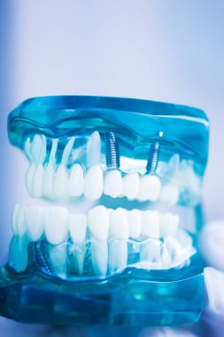 Diş implantı titanyum protez dişçi modeli..