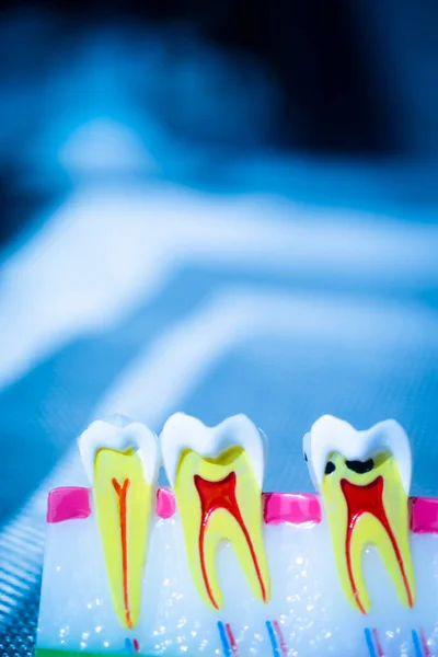 Modelo Dental Que Muestra Caries Dental Encías Conducto Radicular — Foto de Stock