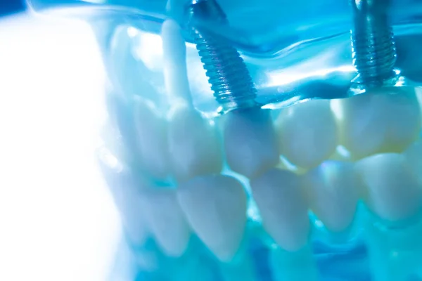 Модель Викладання Стоматологічної Імплантації Зубів Металевих Імплантатах Показують Зуби Ясна — стокове фото
