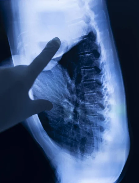 隆起肋骨X光扫描测试结果 — 图库照片
