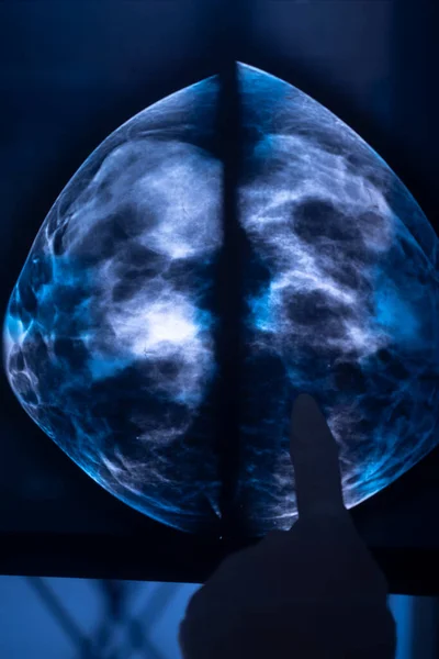 Breast Mamogram Xray Test Scan Result Image Healthy Breasts Cancer — Stock Photo, Image