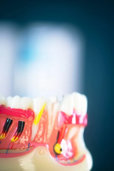 Caries Dental Dentistas Modelo Dental Dientes Encías Conducto Radicular —  Fotos de Stock