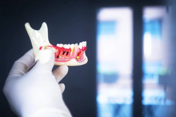 Caries Dental Dentistas Modelo Dental Dientes Encías Conducto Radicular — Foto de Stock
