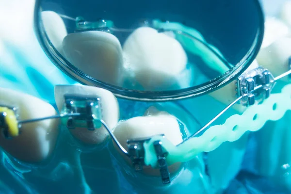 Nowoczesne Metalowe Prostownice Wspornikowe Służące Korygowania Osiowania Zębów Przez Dentystów — Zdjęcie stockowe