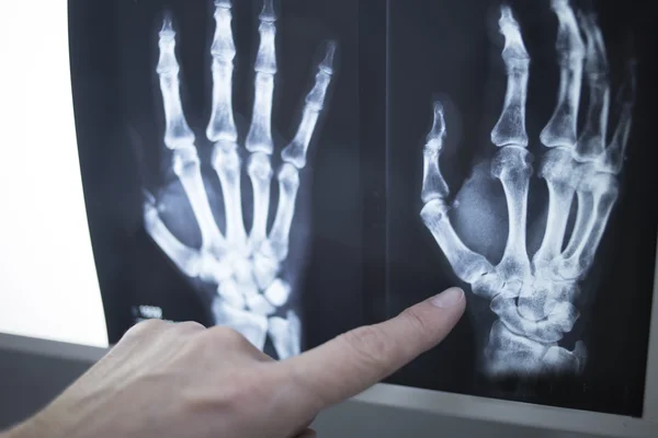 Médico apontando para radiografia radiografia — Fotografia de Stock