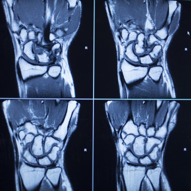 MRI scan test results wrist hand injury clipart