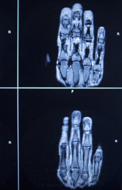 MRI scan test results hand finger injury clipart