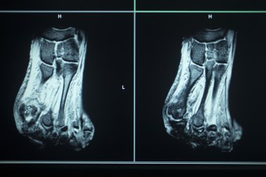 MRI scan test results foot toes injury clipart