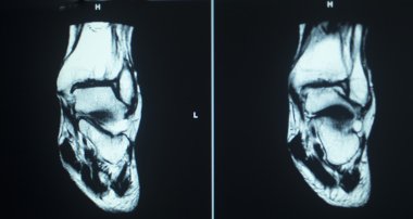 MRI scan test results ankle injury clipart
