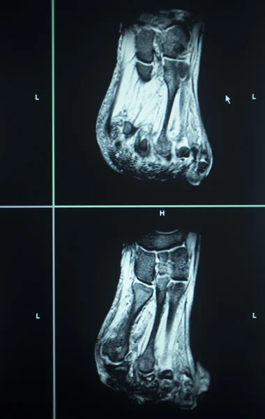 Resultados de la prueba de resonancia magnética Lesiones en los dedos del pie — Foto de Stock