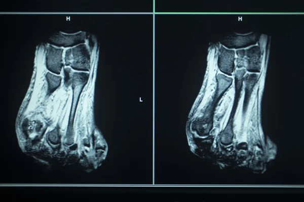 MRI scan test results foot toes injury — Stock Photo, Image