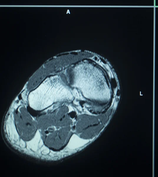 MRI scan test výsledky zranění nohy prsty — Stock fotografie