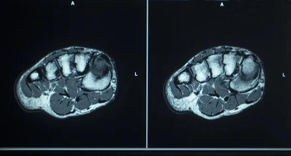 Resultados do exame de ressonância magnética lesão nos dedos dos pés — Fotografia de Stock