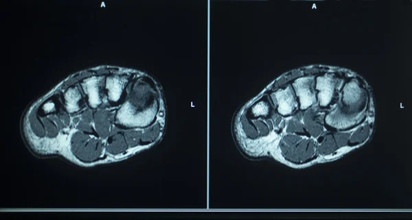 Mri スキャン テスト結果足のつま先のけが — ストック写真