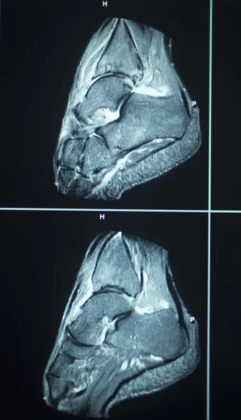 Mri 스캔 테스트 결과 발목 부상 — 스톡 사진