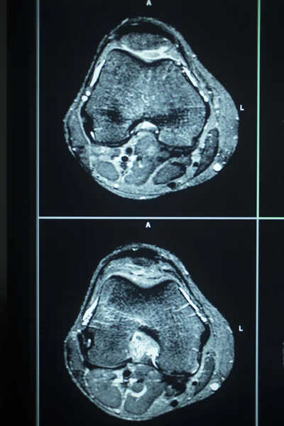 Mri scan test ergebnisse kniemeniskusverletzung — Stockfoto