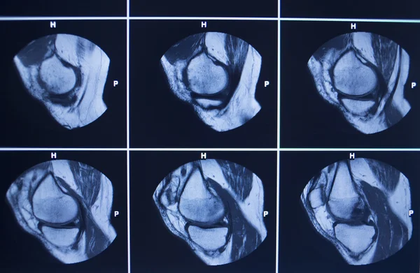 Résultats des tests IRM Lésion du ménisque du genou — Photo