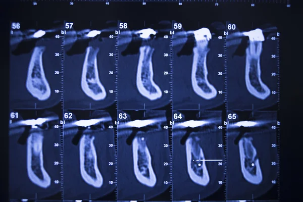 Dentysta dentystyczny ząb xray wyników skanowania — Zdjęcie stockowe