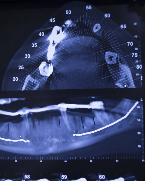 Dentysta dentystyczny ząb xray wyników skanowania — Zdjęcie stockowe