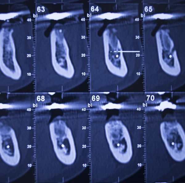 Dentist dental tooth xray scan results