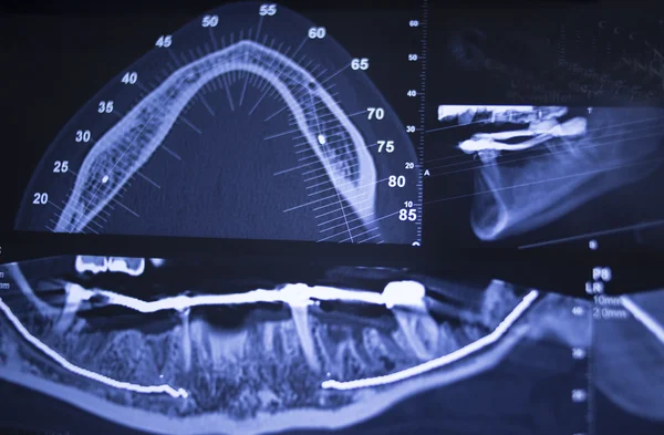 Dentist dental tooth xray scan results — Stock Photo, Image