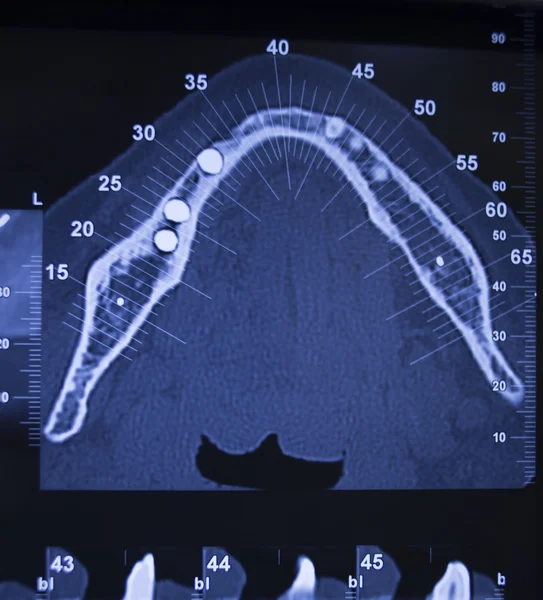 Dentist dental tooth xray scan results — Stock Photo, Image