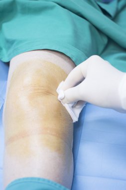Hastane Kliniği Prp enjeksiyon sonra hastada