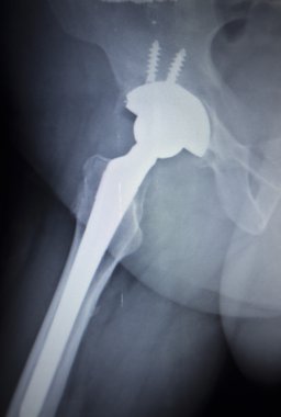 Kalça eklemi replasman ortopedik implant X-Ray tarama görüntü