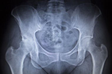 X-ışını ortopedik tarama görüntü kalça eklem insan iskeleti