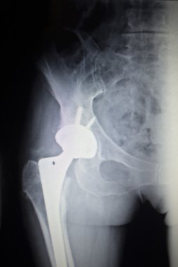 Kalça eklemi replasman ortopedik implant X-Ray tarama görüntü