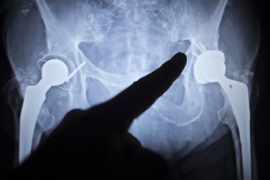 Kalça eklemi replasman ortopedik implant X-Ray tarama görüntü