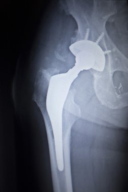 Kalça eklemi replasman ortopedik implant X-Ray tarama görüntü