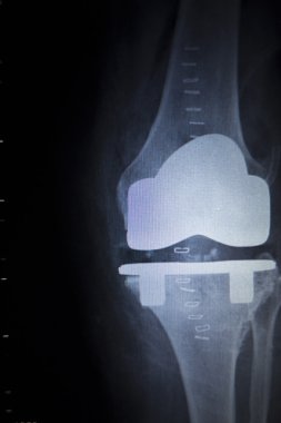 Diz Menisküs implant protez ortopedi tarama x-ışını