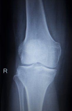 X-ışını ortopedi tarama ağrılı diz Menisküs bacak yaralanma