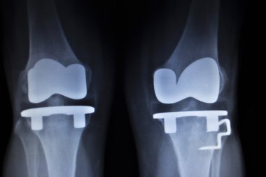 Diz Menisküs implant protez ortopedi tarama x-ışını
