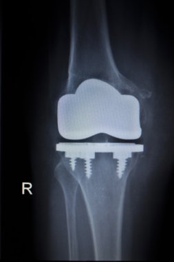 X-ray orthopedics scan of knee meniscus implant prosthetics clipart