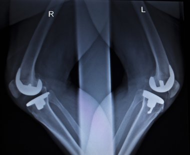 Diz Menisküs implant protez ortopedi tarama x-ışını