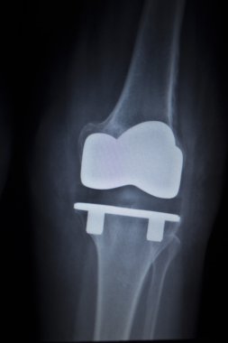 Diz Menisküs implant protez ortopedi tarama x-ışını