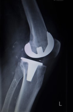 Diz Menisküs implant protez ortopedi tarama x-ışını