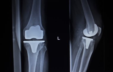 Diz Menisküs implant protez ortopedi tarama x-ışını
