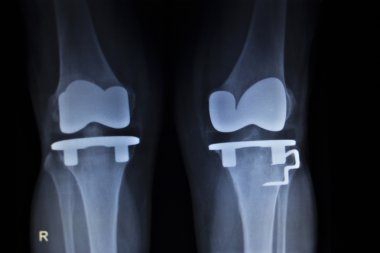 Diz Menisküs implant protez ortopedi tarama x-ışını