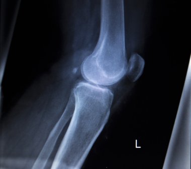 X-ışını ortopedi tarama ağrılı diz Menisküs bacak yaralanma