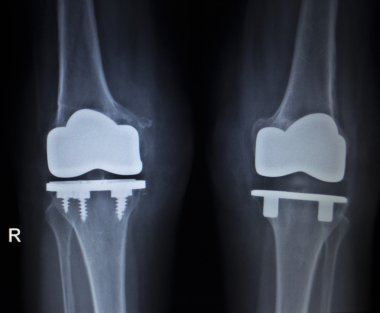 Diz Menisküs implant protez ortopedi tarama x-ışını