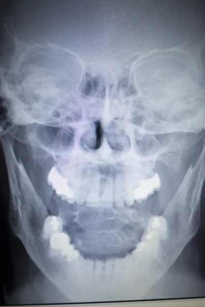 Radiografía ortopédica Traumatología exploración nariz lesión respiración — Foto de Stock