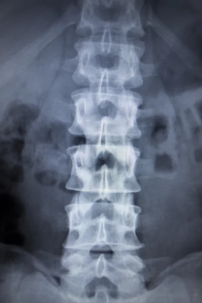 Ortopedia por rayos X Traumatología exploración dolor de espalda lesión en la columna vertebral — Foto de Stock
