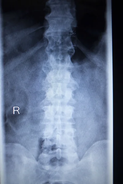 Ortopedia por rayos X Traumatología exploración dolor de espalda lesión en la columna vertebral — Foto de Stock