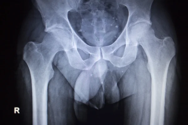 X-ray ortopedické scan image kyčelních kloubů lidská kostra — Stock fotografie