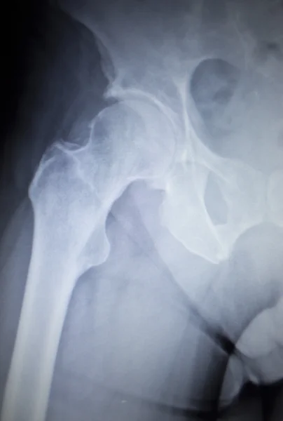 髋关节置换骨科植入物的 x 射线扫描图像 — 图库照片