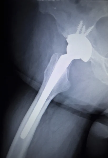 X-ray scan  image of hip joint replacement orthopedic implant — Stock Photo, Image